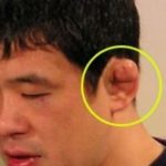 cauliflower-ear