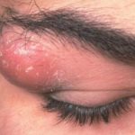 cyst-on-face-above-the-eye