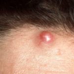 cyst-on-forehead-image