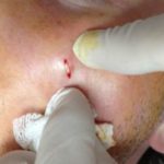 cyst-on-face-removal