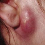 ear-infection-causing-bumps-behind-ear