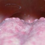 enlarged-white-bumps-on-back-of-tongue-and-throat