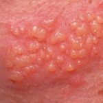 genital-herpes-apppearing-as-small-dots