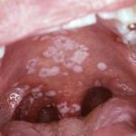 image-of-white-patches-inside-mouth-and-throat