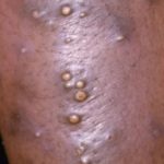 infected-boils-are-usually-painful