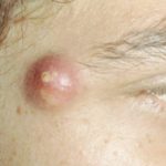 infected-cyst-on-face