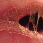 inside-of-mouth-peeling-causes