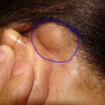 large-bump-behind-ear-lipoma