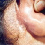 mastoiditis-infection-on-ear