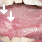 oral-cancer-appear-as-mouth-white-patches