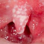 oral-thrush-causing-mouth-white-patches