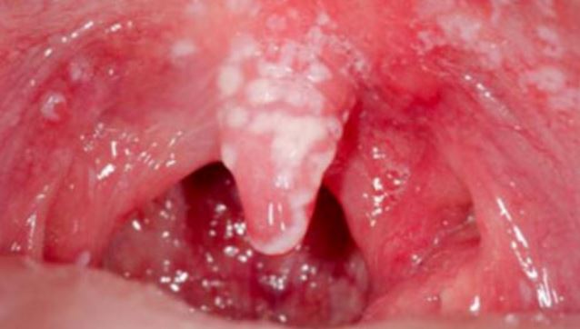 White Patches in Mouth, Back of Throat, Pictures, Causes