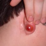 painful-abscess-behind-ear