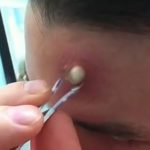 popping-a-cyst-on-forehead