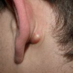 small-bump-behind-ear