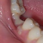 small-white-bump-on-gums-oral-herpes