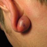 swollen-ear-lobe-picture