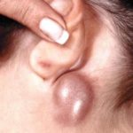 swollen-lymph-nodes-behind-ear