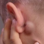 swollen-lymph-nodes-behind-ear-picture