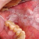 white-patches-in-mouth-leukoplakiais