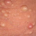 white-pimple-like-bumps-on-testicle-sac