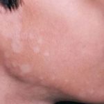 white-spots-on-skin