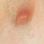 a-cyst-developing-in-armpit-image