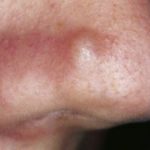 a-cyst-on-nose-image