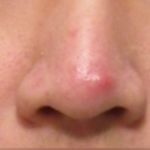 a-sebaceous-cyst-on-nose-tip