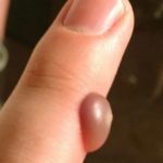 blood-blister-on-finger-image