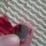 blood-blister-on-finger-under-nail