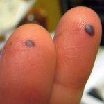 blood-blister-on-fingers