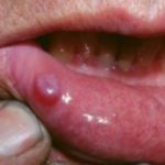 blood-blister-on-inside-lip-image