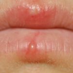 blood-blister-on-lip-symptoms