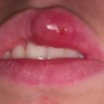 blood-blister-on-upper-lip-image