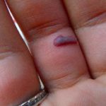 blood-blood-blister-on-finger-under-skin