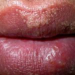 bumps-on-lips-picture