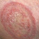 circular-rash-on-armpit-itchy-from-candida-picture