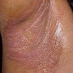 contact-dermatitis-causing-severe-itch-underarm