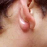 cyst-beind-ear