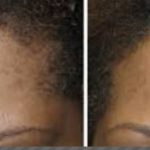 forehead-osteomas-before-and-after-treatment-picture