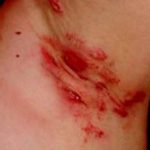 hidradenitis-suppurativa-underarm