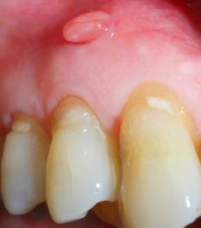 gum boil abscess symptoms causes boils child pain remedies