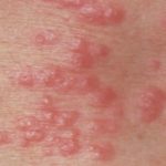 itchy-bumps-on-inner-thigh