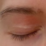 itchy-eyebrows-eczema