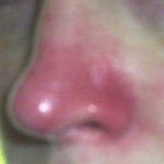 itchy-nose-symptoms