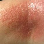 itchy-rash-in-elbow-crease