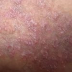 itchy-rash-on-inner-thigh