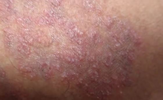 swimmers itch on penis