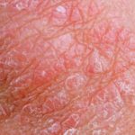 itchy-testicles-skin-symptoms